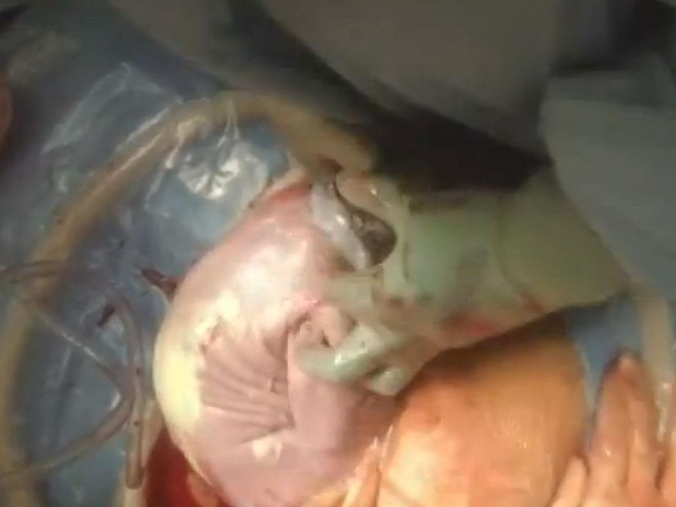 C-Section, Memorial Hermann, first sight of baby, February 2013